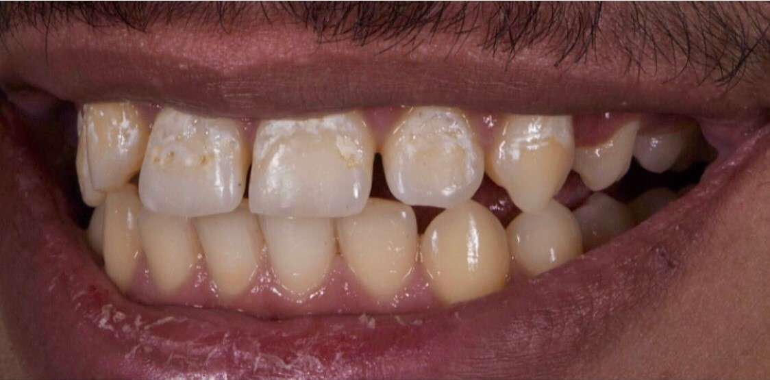 Teeth2