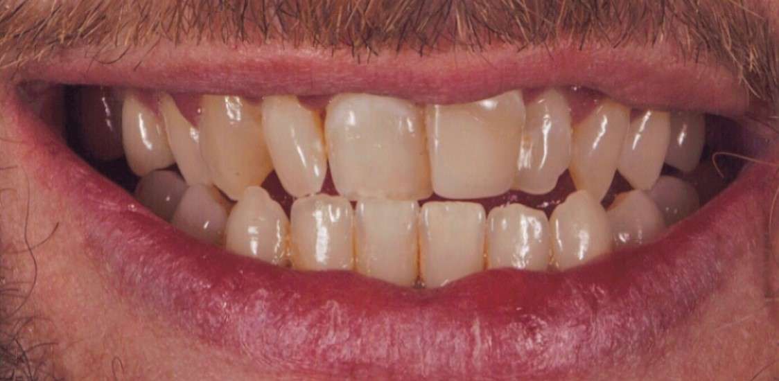 Teeth8